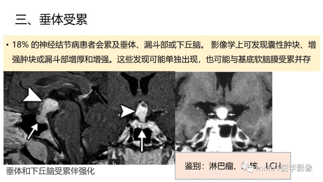 影像PPT - 【PPT】双侧海绵窦结节病—神经结节病综述-27