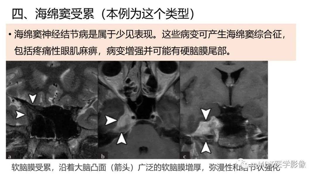 影像PPT - 【PPT】双侧海绵窦结节病—神经结节病综述-28