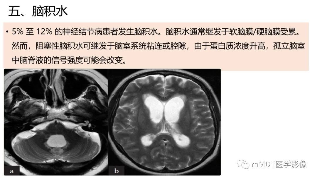 影像PPT - 【PPT】双侧海绵窦结节病—神经结节病综述-29