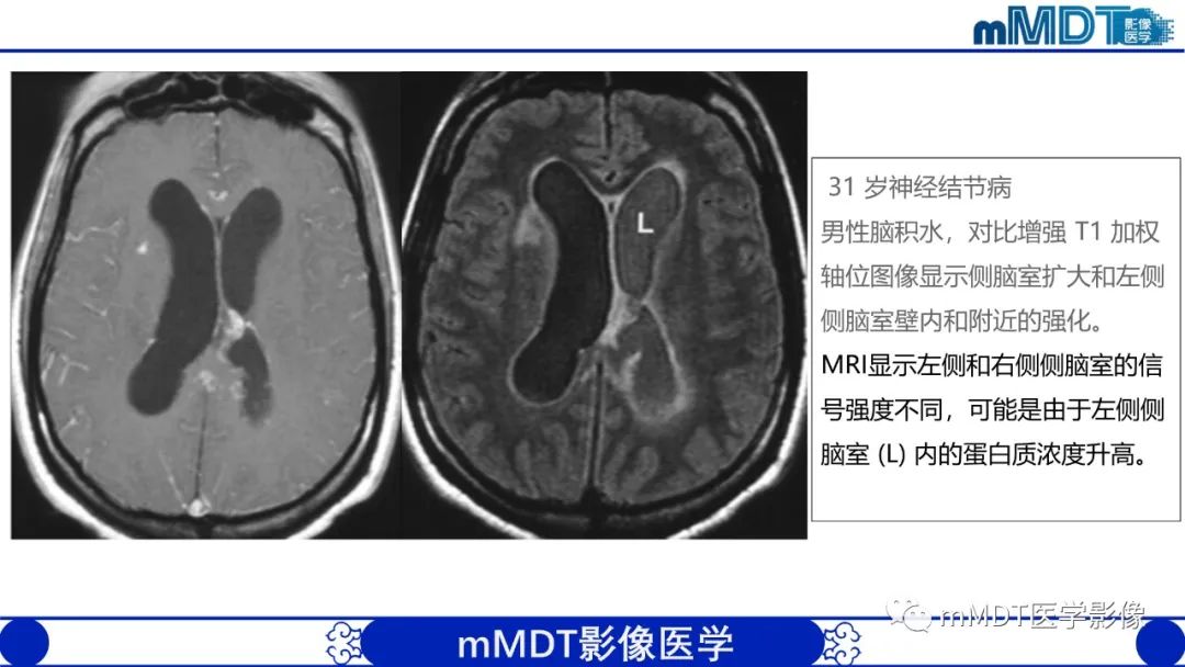 影像PPT - 【PPT】双侧海绵窦结节病—神经结节病综述-30