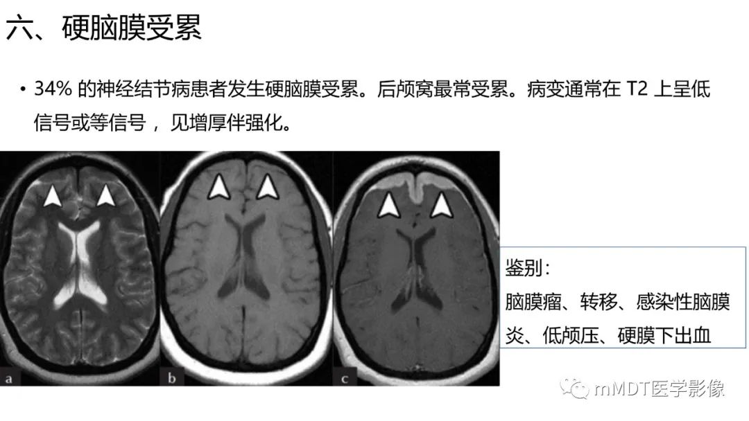 影像PPT - 【PPT】双侧海绵窦结节病—神经结节病综述-31