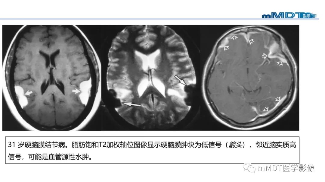 影像PPT - 【PPT】双侧海绵窦结节病—神经结节病综述-32