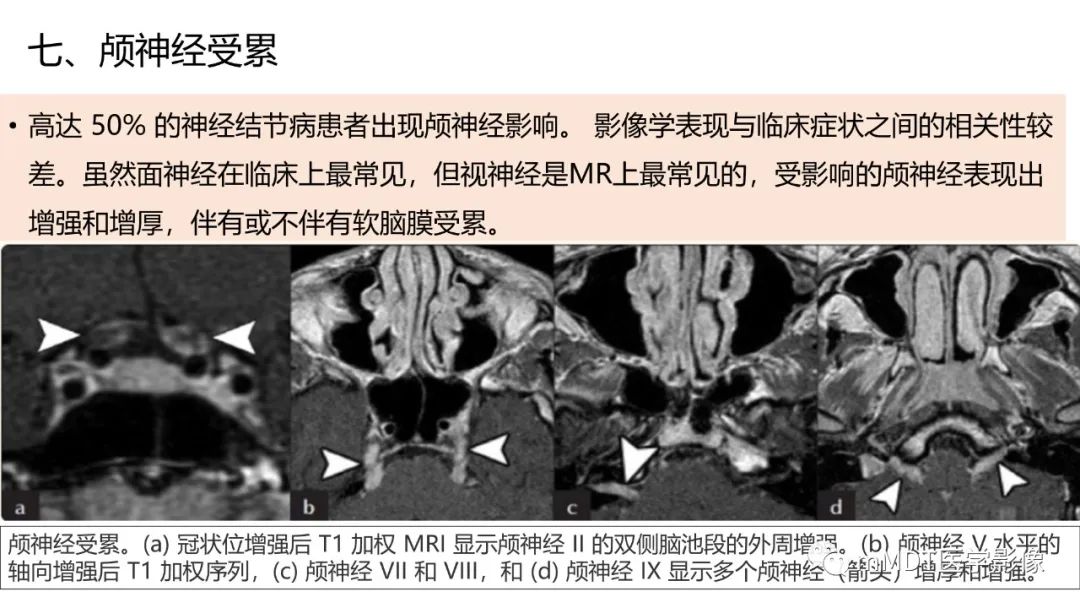 影像PPT - 【PPT】双侧海绵窦结节病—神经结节病综述-33