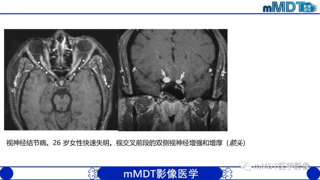 影像PPT - 【PPT】双侧海绵窦结节病—神经结节病综述-34