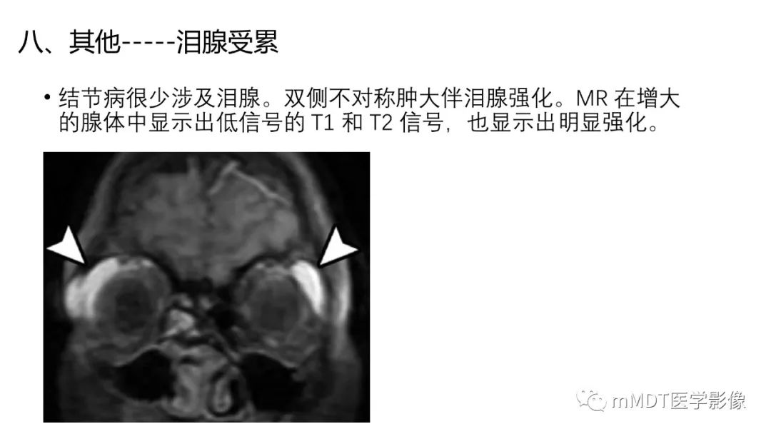 影像PPT - 【PPT】双侧海绵窦结节病—神经结节病综述-35