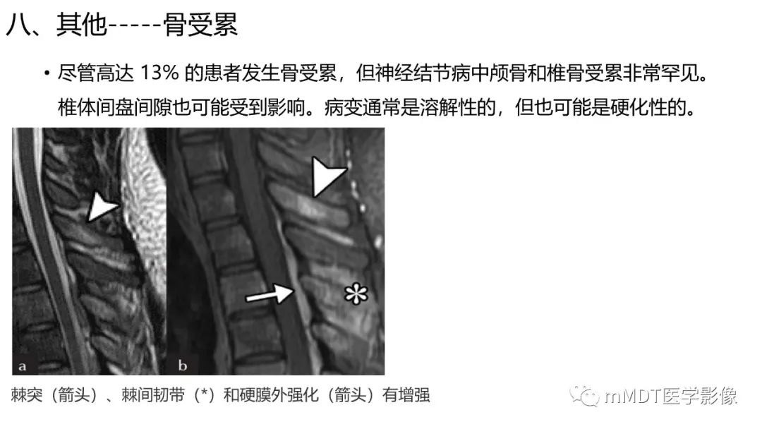 影像PPT - 【PPT】双侧海绵窦结节病—神经结节病综述-36