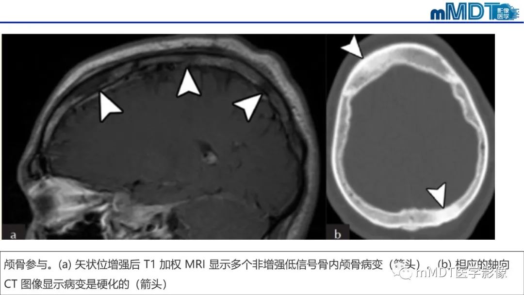 影像PPT - 【PPT】双侧海绵窦结节病—神经结节病综述-37