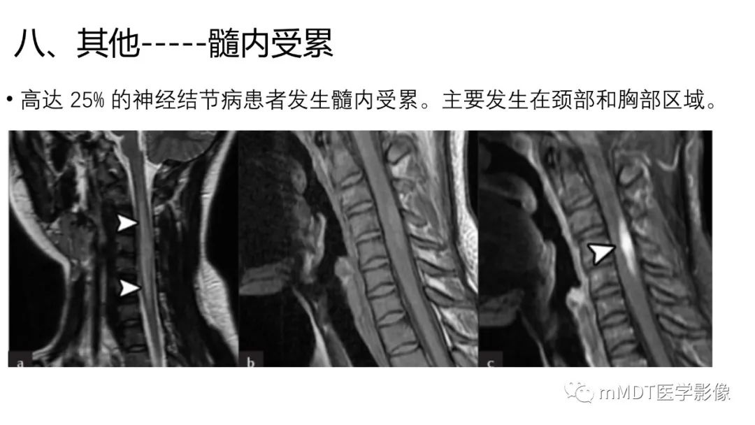 影像PPT - 【PPT】双侧海绵窦结节病—神经结节病综述-38