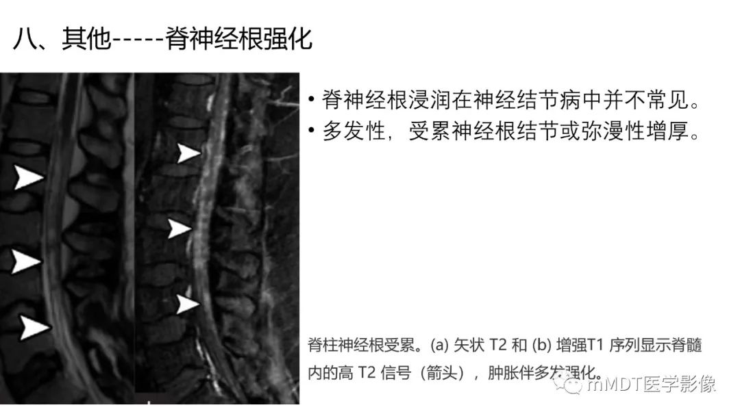 影像PPT - 【PPT】双侧海绵窦结节病—神经结节病综述-39