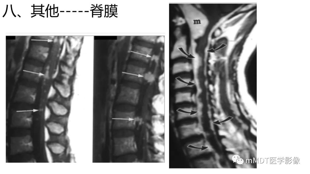影像PPT - 【PPT】双侧海绵窦结节病—神经结节病综述-40