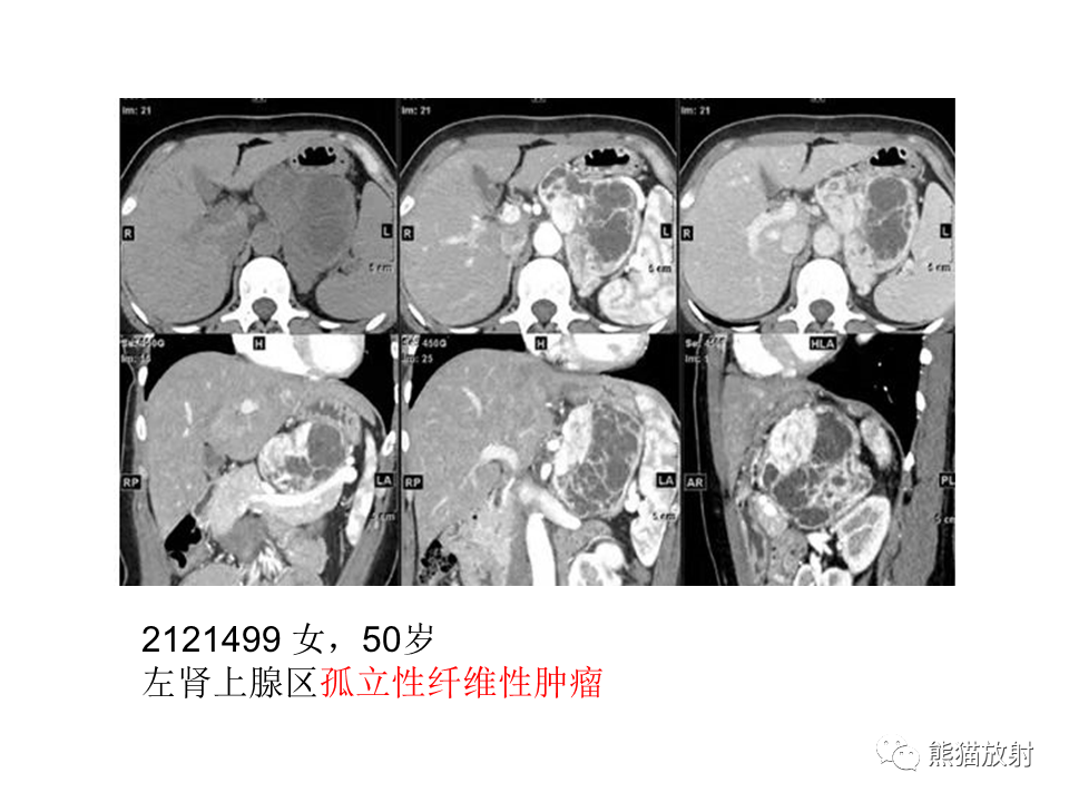 影像PPT - 【病例】腹膜后神经鞘瘤 VS Castleman病-25