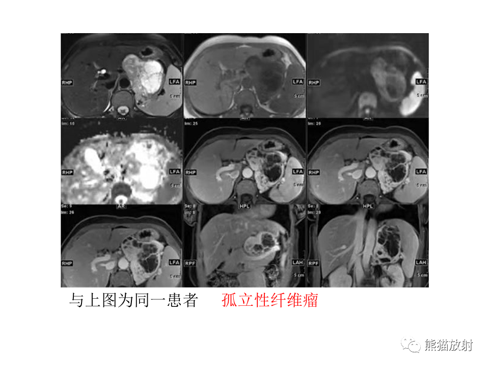 影像PPT - 【病例】腹膜后神经鞘瘤 VS Castleman病-26