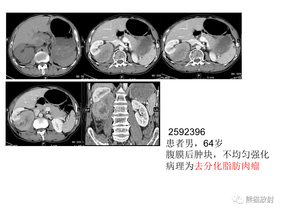 影像PPT - 【病例】腹膜后神经鞘瘤 VS Castleman病-28