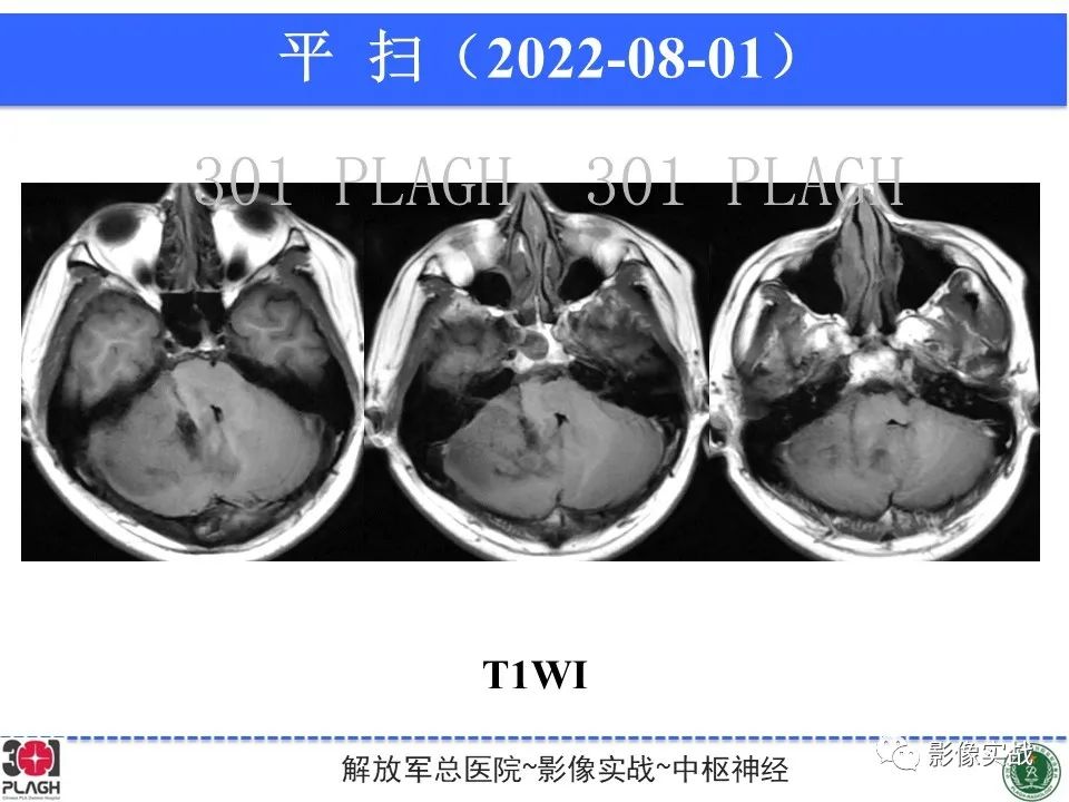 影像PPT - 【病例】成人小脑髓母细胞瘤1例MR影像-5