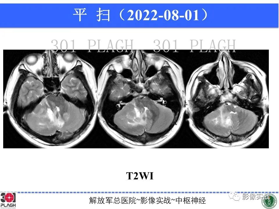 影像PPT - 【病例】成人小脑髓母细胞瘤1例MR影像-4