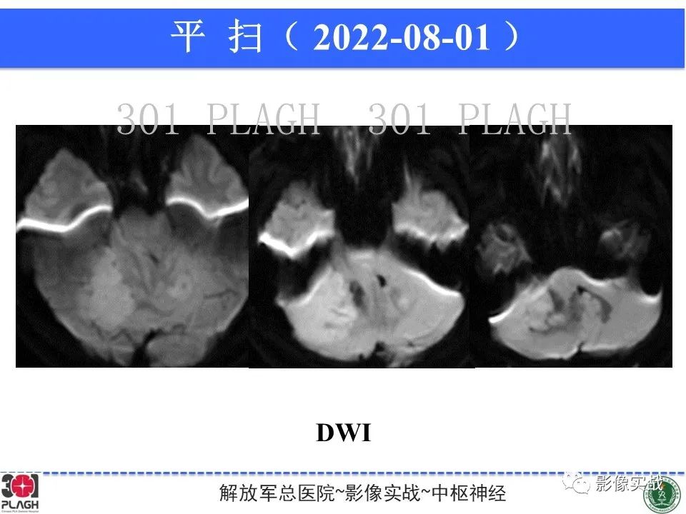 影像PPT - 【病例】成人小脑髓母细胞瘤1例MR影像-6