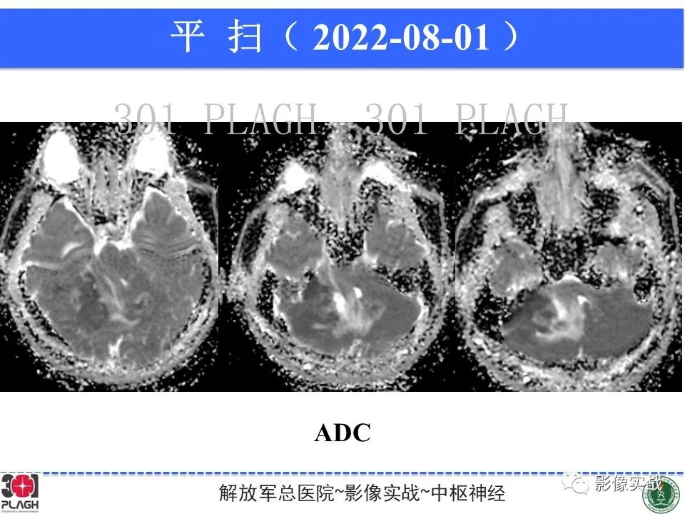 影像PPT - 【病例】成人小脑髓母细胞瘤1例MR影像-7