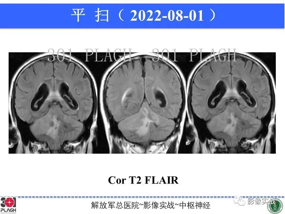 影像PPT - 【病例】成人小脑髓母细胞瘤1例MR影像-8