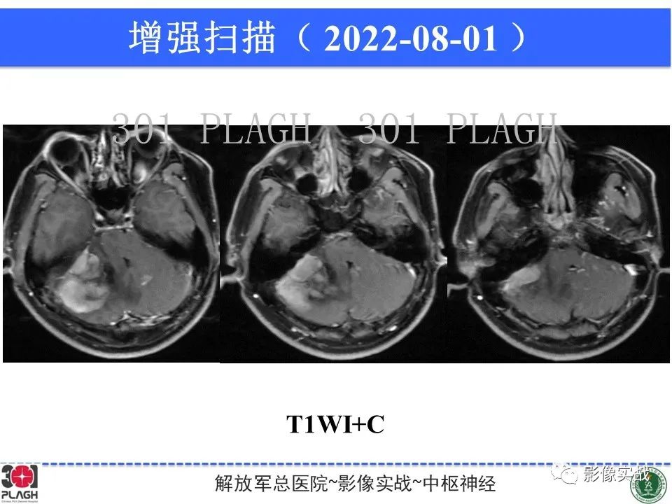 影像PPT - 【病例】成人小脑髓母细胞瘤1例MR影像-9