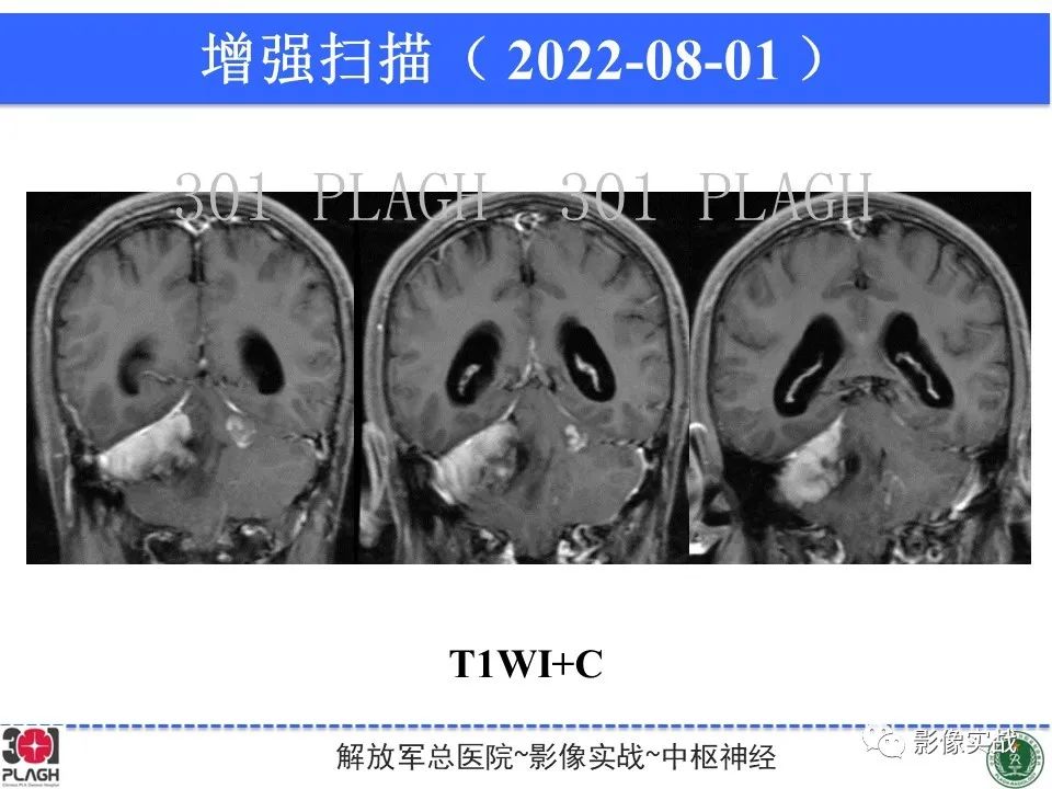 影像PPT - 【病例】成人小脑髓母细胞瘤1例MR影像-10