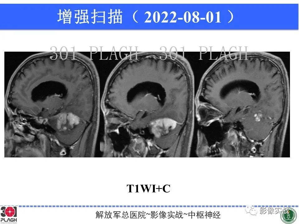 影像PPT - 【病例】成人小脑髓母细胞瘤1例MR影像-11