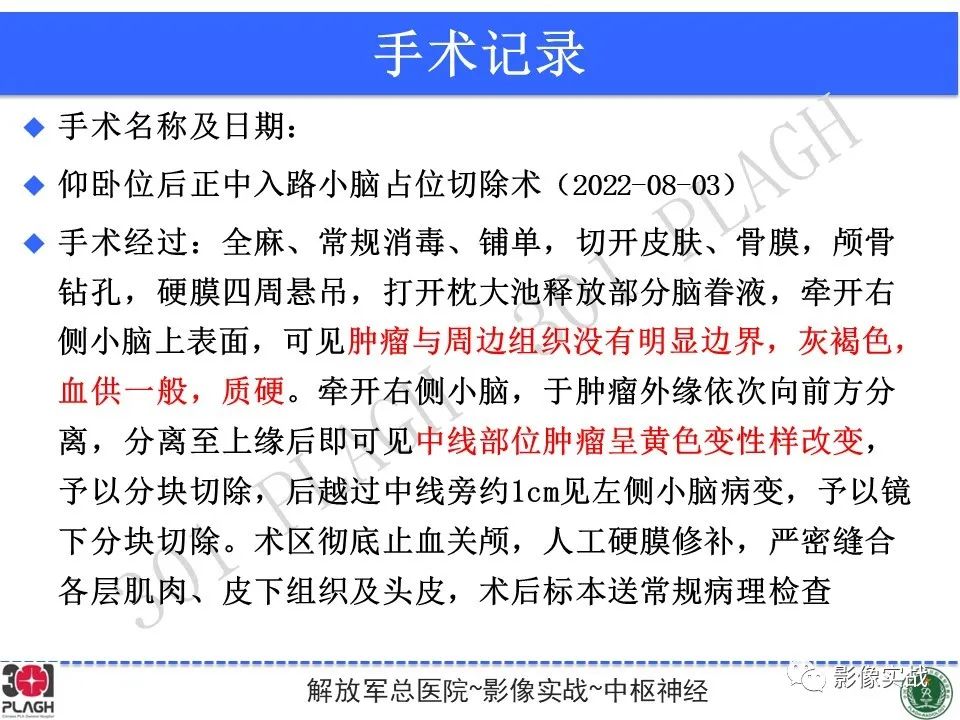 影像PPT - 【病例】成人小脑髓母细胞瘤1例MR影像-18
