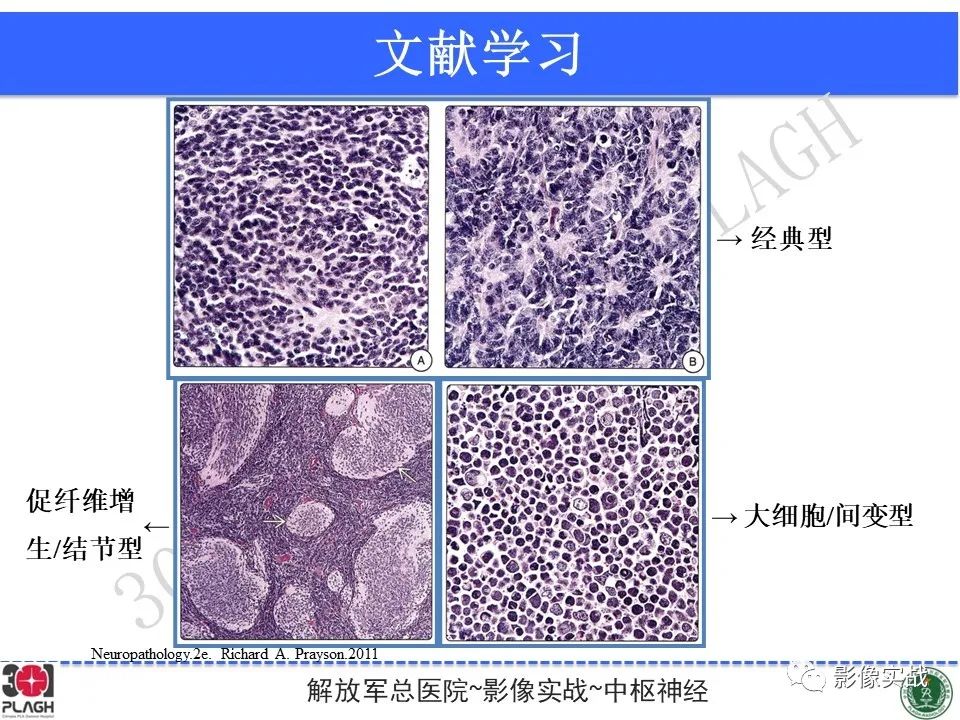 影像PPT - 【病例】成人小脑髓母细胞瘤1例MR影像-22