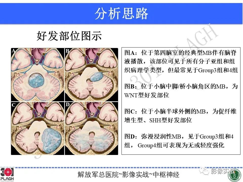 影像PPT - 【病例】成人小脑髓母细胞瘤1例MR影像-24