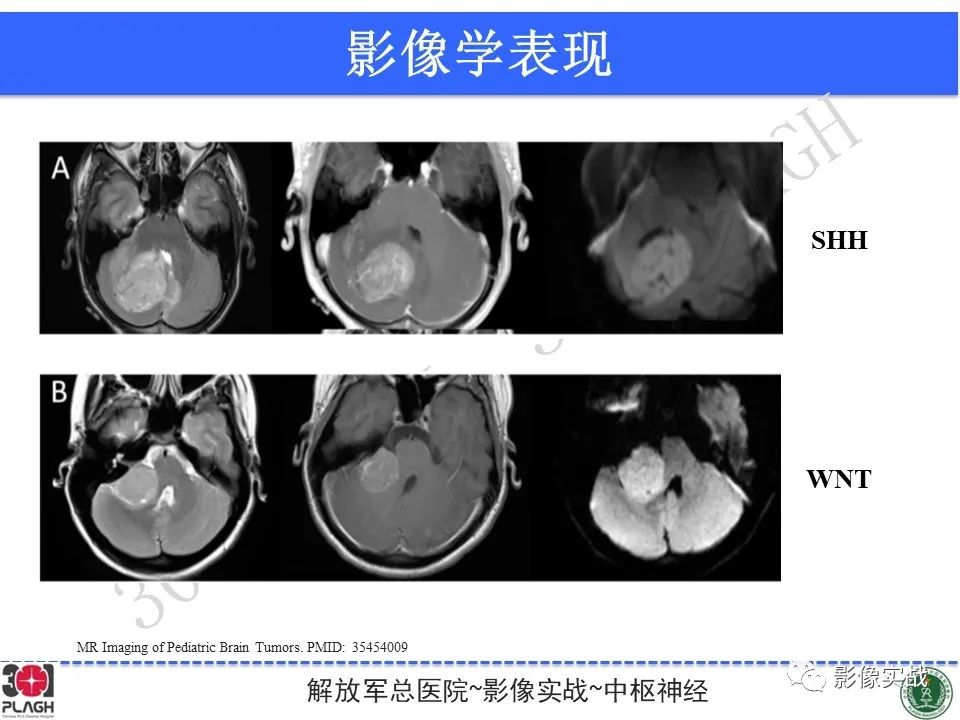 影像PPT - 【病例】成人小脑髓母细胞瘤1例MR影像-26