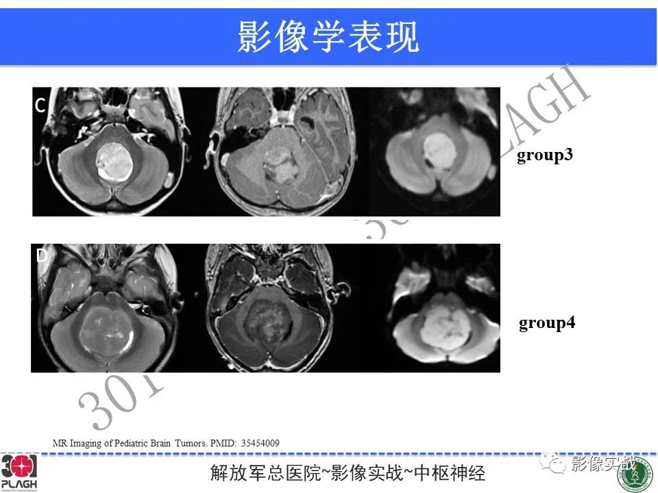 影像PPT - 【病例】成人小脑髓母细胞瘤1例MR影像-27