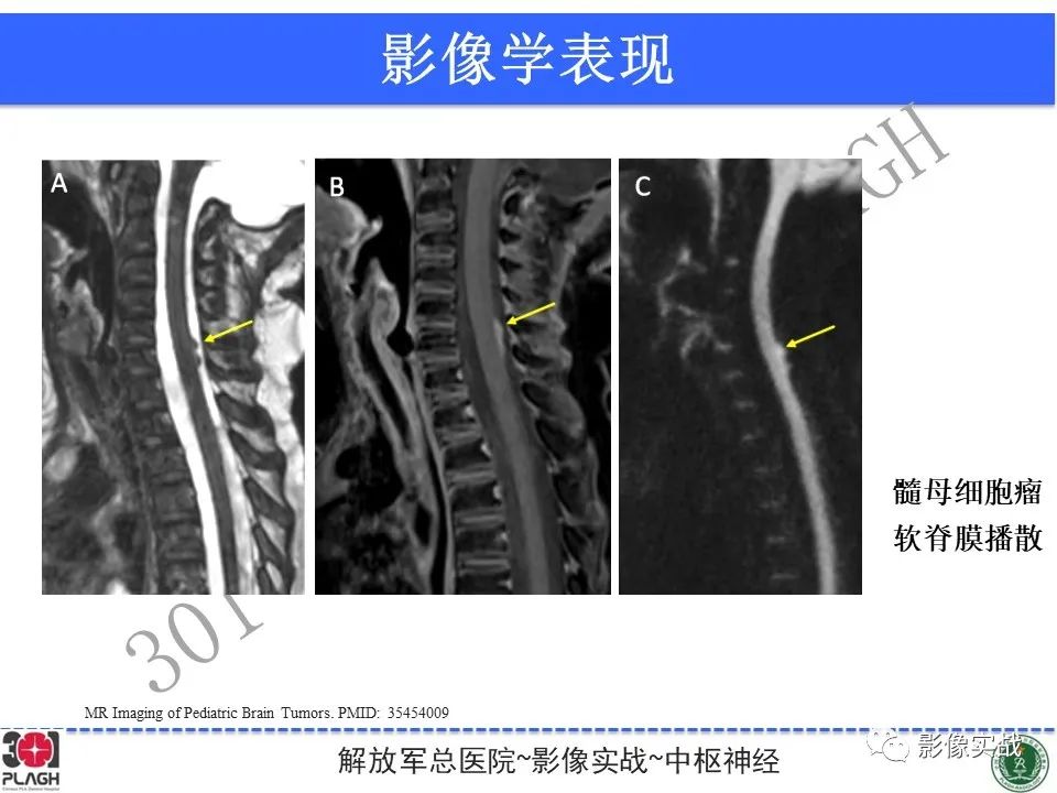 影像PPT - 【病例】成人小脑髓母细胞瘤1例MR影像-28