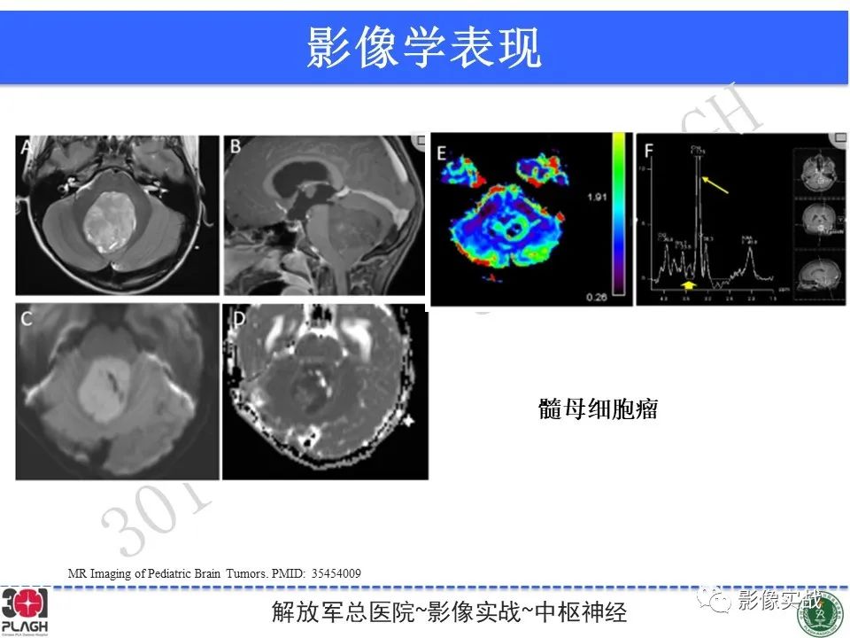 影像PPT - 【病例】成人小脑髓母细胞瘤1例MR影像-29