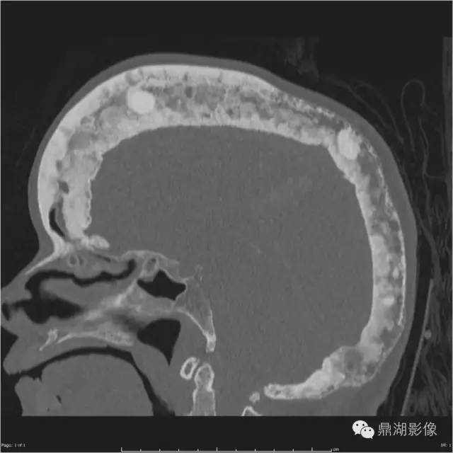 影像PPT - 棉絮征—佩吉特骨病-4 影像PPT - 棉絮征—佩吉特骨病-4