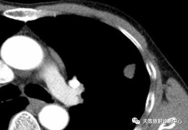 影像PPT - 结核肉芽肿性病变—结核瘤及纤维干酪结节-3 影像PPT - 结核肉芽肿性病变—结核瘤及纤维干酪结节-3