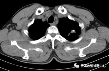 影像PPT - 结核肉芽肿性病变—结核瘤及纤维干酪结节-7