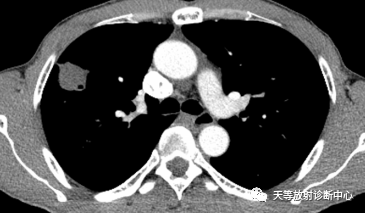 影像PPT - 结核肉芽肿性病变—结核瘤及纤维干酪结节-8 影像PPT - 结核肉芽肿性病变—结核瘤及纤维干酪结节-8
