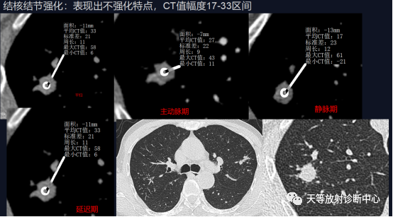 影像PPT - 结核肉芽肿性病变—结核瘤及纤维干酪结节-9 影像PPT - 结核肉芽肿性病变—结核瘤及纤维干酪结节-9