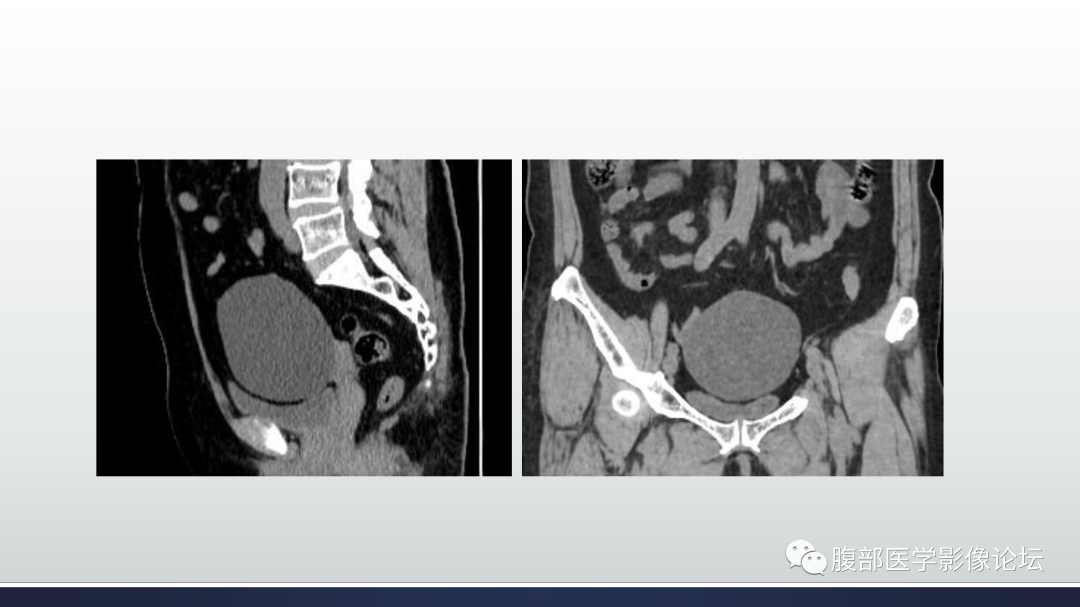 影像PPT - 【病例】卵巢浆液性囊腺瘤1例CT及MR影像-13