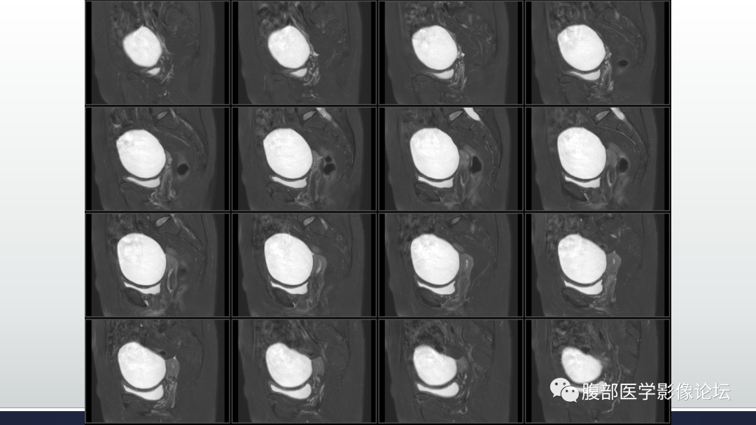 影像PPT - 【病例】卵巢浆液性囊腺瘤1例CT及MR影像-17