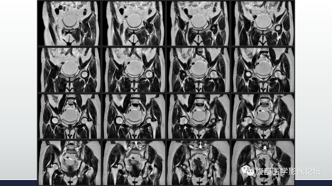 影像PPT - 【病例】卵巢浆液性囊腺瘤1例CT及MR影像-16