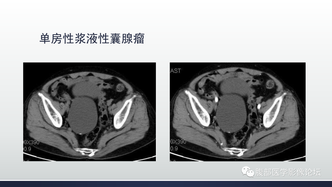 影像PPT - 【病例】卵巢浆液性囊腺瘤1例CT及MR影像-36