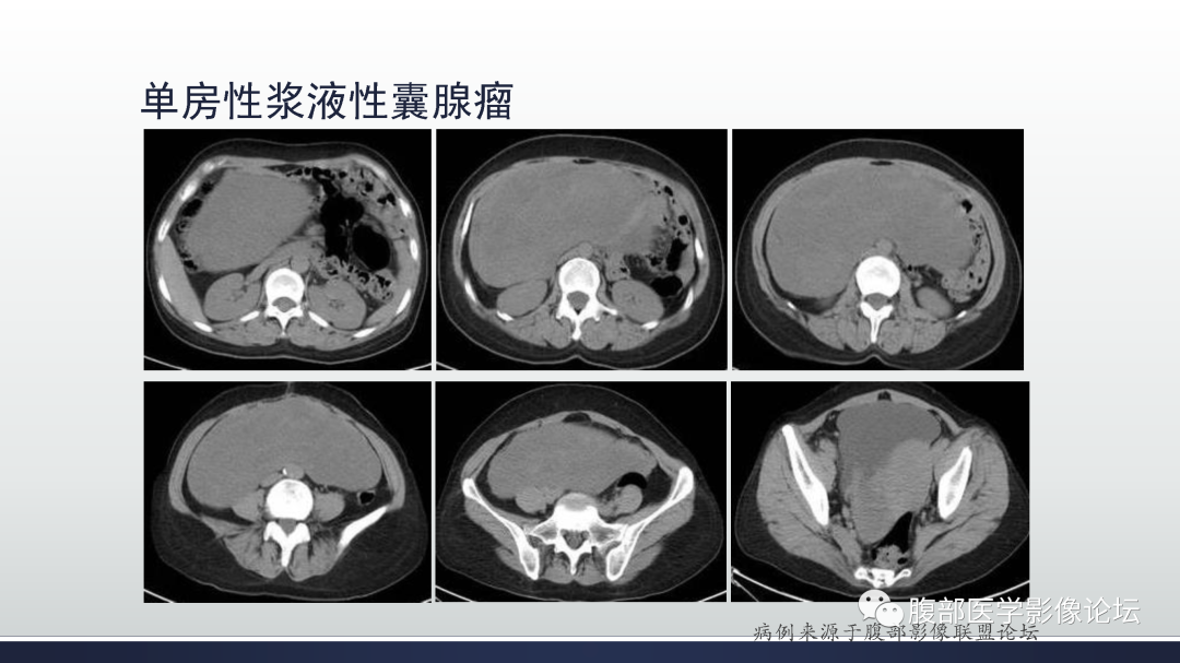 影像PPT - 【病例】卵巢浆液性囊腺瘤1例CT及MR影像-37
