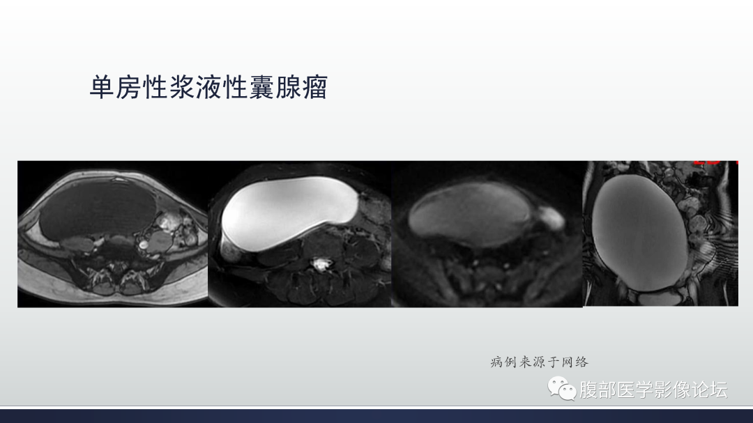 影像PPT - 【病例】卵巢浆液性囊腺瘤1例CT及MR影像-38