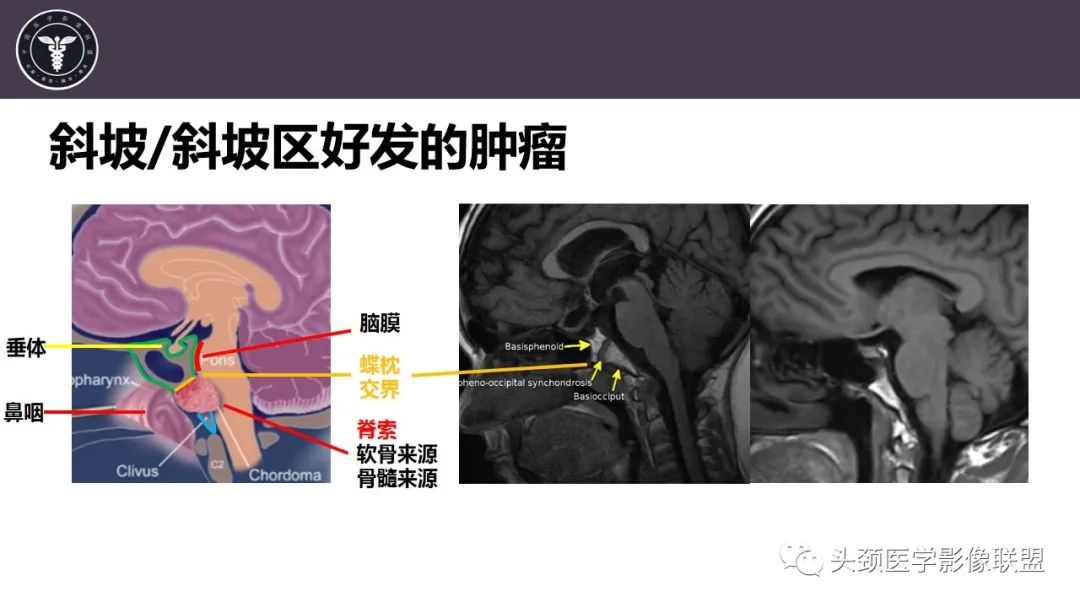 影像PPT - 【病例】斜坡区骨巨细胞瘤 VS 脊索瘤-14