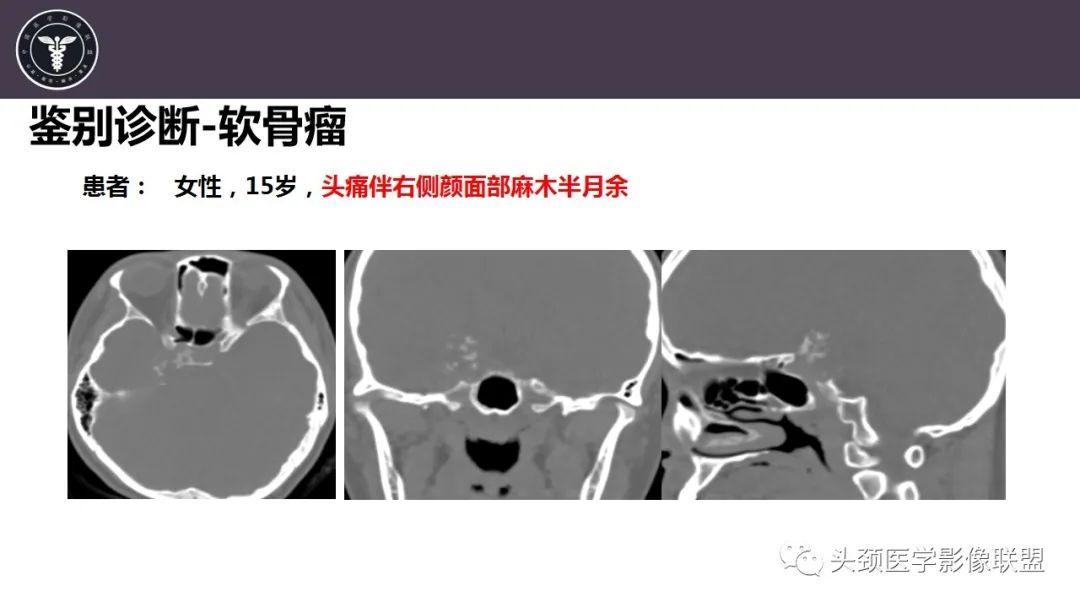 影像PPT - 【病例】斜坡区骨巨细胞瘤 VS 脊索瘤-23