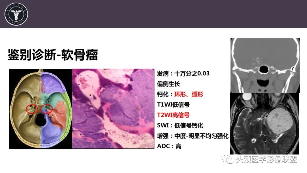 影像PPT - 【病例】斜坡区骨巨细胞瘤 VS 脊索瘤-25