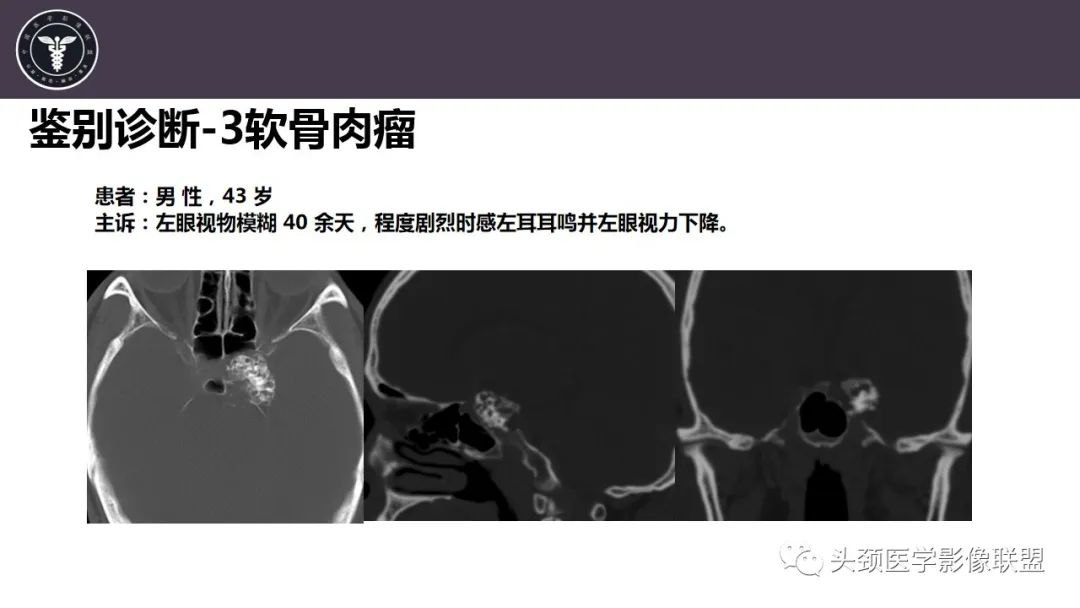 影像PPT - 【病例】斜坡区骨巨细胞瘤 VS 脊索瘤-26