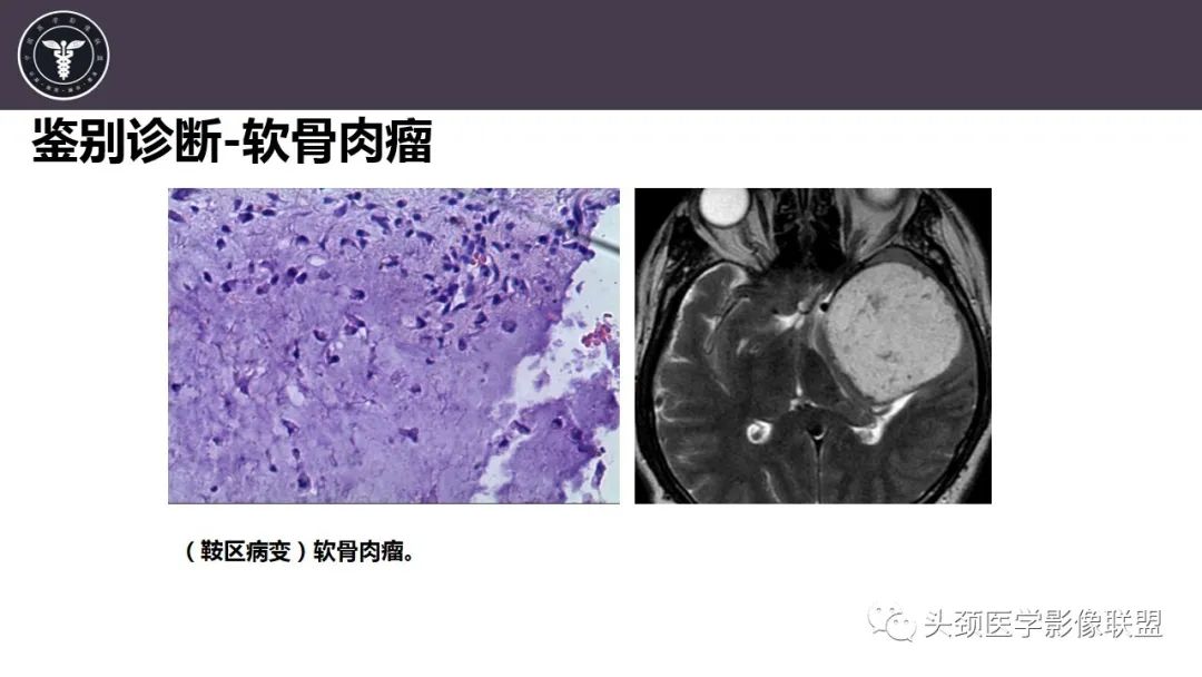 影像PPT - 【病例】斜坡区骨巨细胞瘤 VS 脊索瘤-28