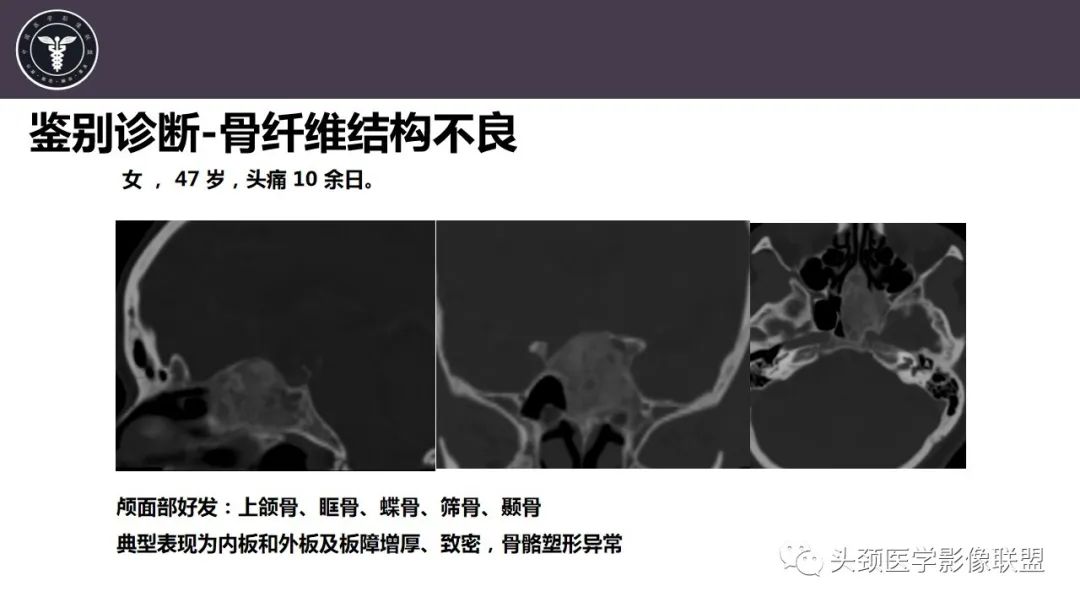 影像PPT - 【病例】斜坡区骨巨细胞瘤 VS 脊索瘤-29