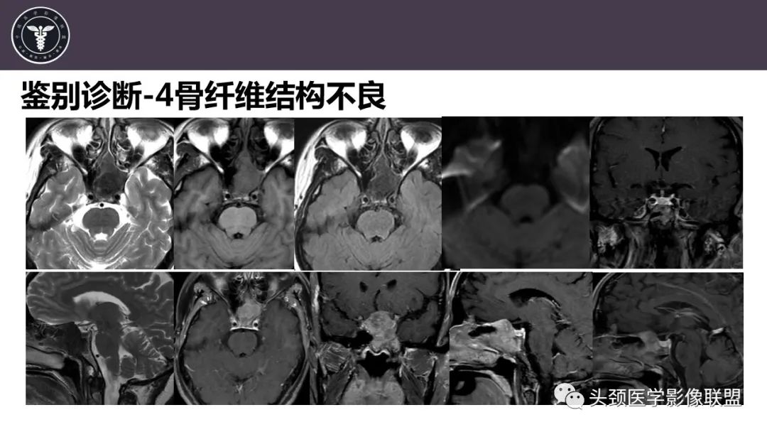 影像PPT - 【病例】斜坡区骨巨细胞瘤 VS 脊索瘤-30